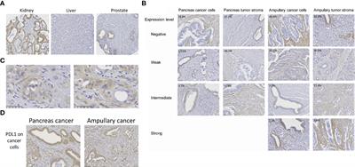 Cancer Cell B7-H3 Expression Is More Prevalent in the Pancreato-Biliary Subtype of Ampullary Cancer Than in Pancreatic Cancer